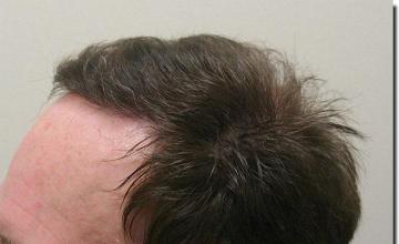 Hair restoration procedure results