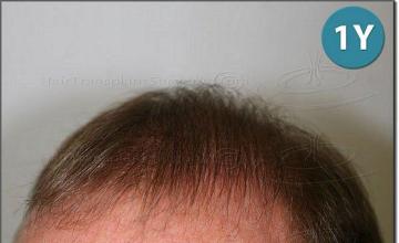 Hair restoration procedure results