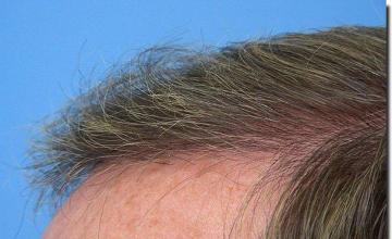 Hair restoration procedure results