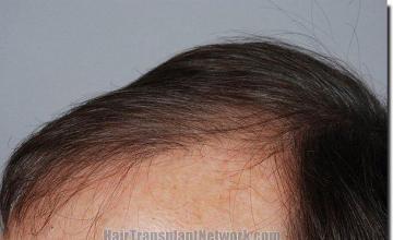 Hair restoration procedure results