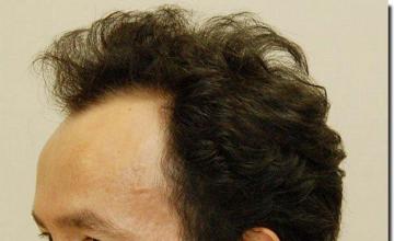 Hair restoration procedure results