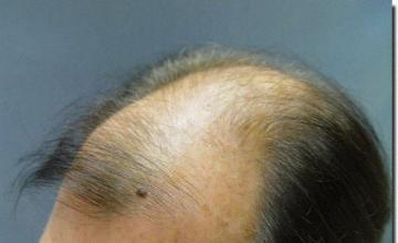 Hair restoration procedure results