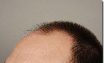 Hair restoration procedure results