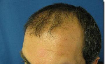 Hair restoration procedure results