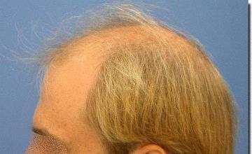 Hair restoration procedure results