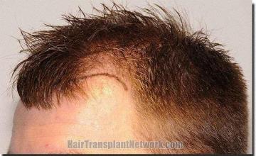 Hair restoration procedure results