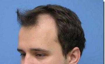 Hair restoration procedure results