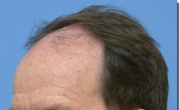 Hair restoration procedure results