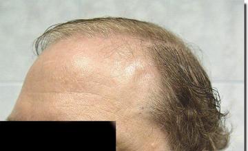 Hair restoration procedure results