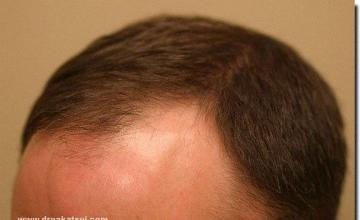 Hair restoration procedure results