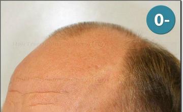 Hair restoration procedure results