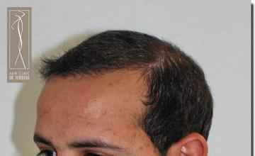 Hair restoration procedure results