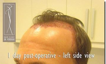 Hair restoration procedure results