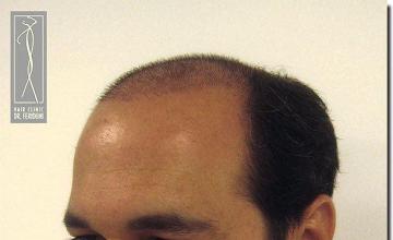 Hair restoration procedure results