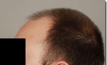 Hair restoration procedure results