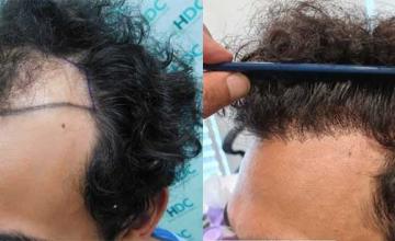 Left side of patient, before and after hair transplant