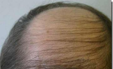 Hair restoration procedure results