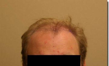 Hair restoration procedure results