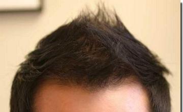 Hair restoration procedure results