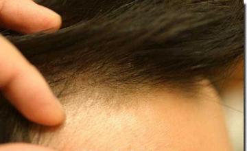 Hair restoration procedure results