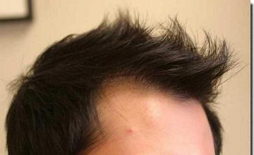 Hair restoration procedure results