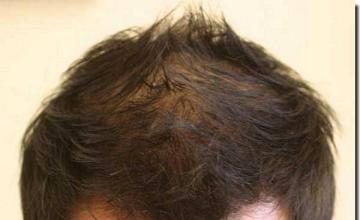 Hair restoration procedure results