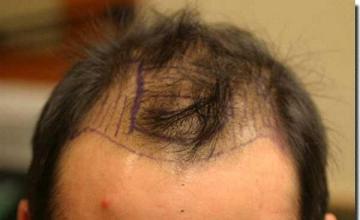 Hair restoration procedure results