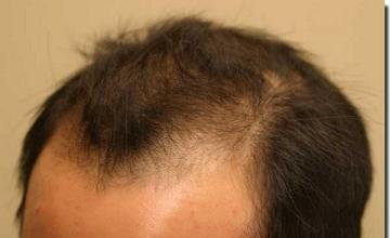 Hair restoration procedure results