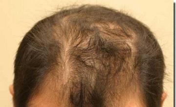 Hair restoration procedure results