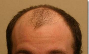 Hair restoration procedure results