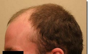 Hair restoration procedure results