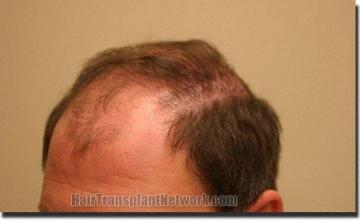 Hair restoration procedure results