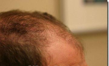 Hair restoration procedure results