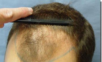 Hair restoration procedure results