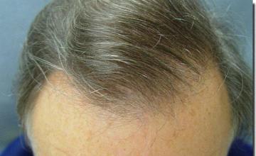 Hair restoration procedure results