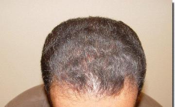 Hair restoration procedure results