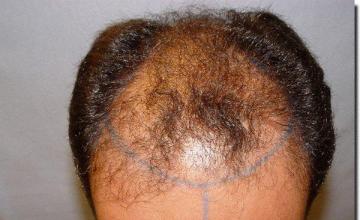 Hair restoration procedure results