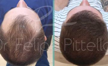 Overhead view before and after FUE hair transplant