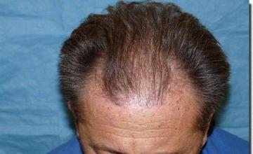 Hair restoration procedure results