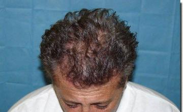 Hair restoration procedure results