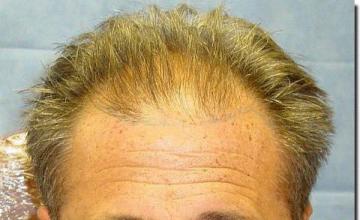 Hair restoration procedure results