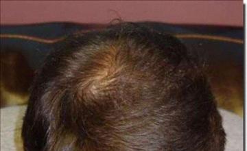 Hair restoration procedure results