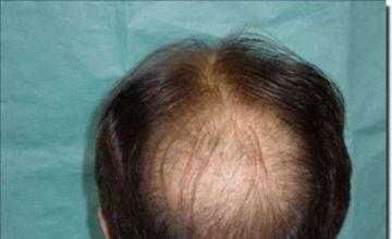 Hair restoration procedure results