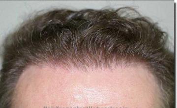 Hair restoration procedure results