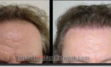 Hair restoration procedure results