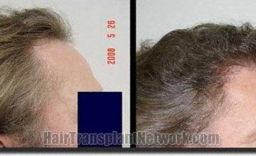 Hair restoration procedure results