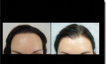 Hair restoration procedure results