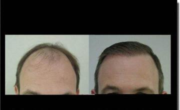 Hair restoration procedure results