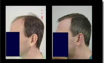 Hair restoration procedure results