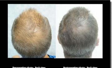 Hair restoration procedure results